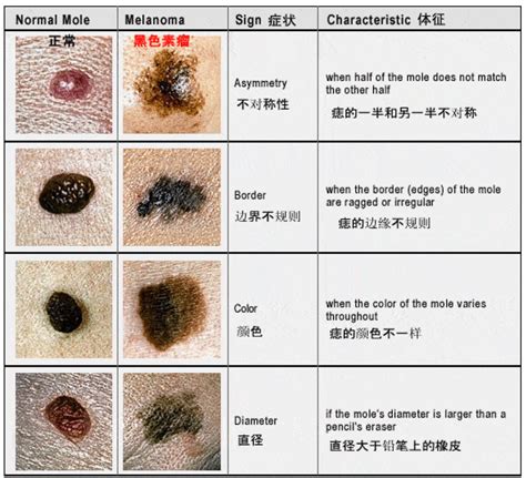 手臂上的痣|痣也可能会癌变！长在 3 个地方要注意